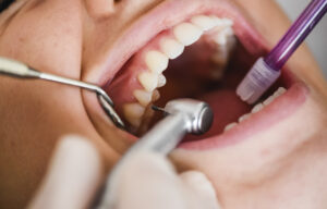 Tratamiento dental para caries en la Clínica Elena Queral en Castellón.