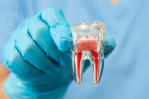 Modelo anatómico de un diente con pulpa dental en rojo, sostenido por un dentista con guantes azules, representando el tratamiento de endodoncia en Castellón.
