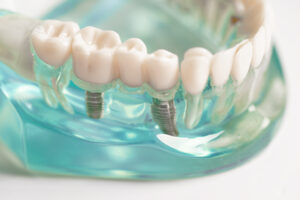 Modelo dental mostrando implantes integrados en la mandíbula, utilizado en Clínica Elena Queral en Castellón