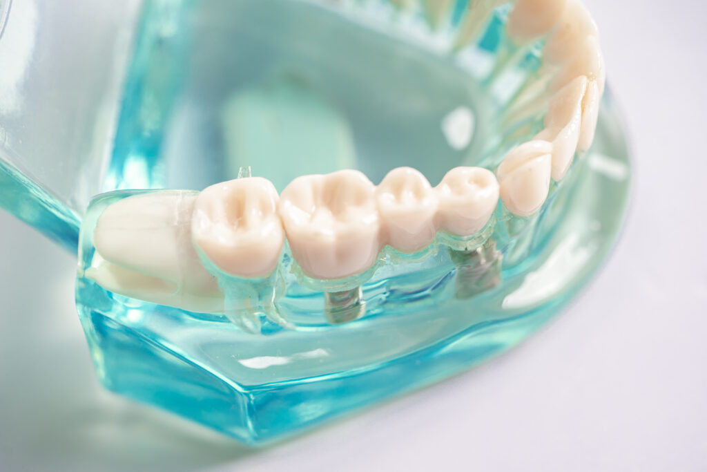Modelo dental con implantes dentales colocados en una prótesis fija sobre encía transparente