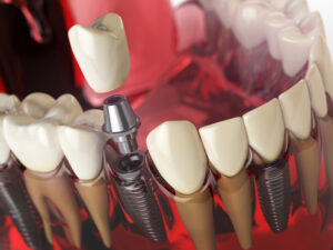 Implante dental en modelo 3D mostrando encía, tornillo y corona – Clínica Elena Queral en Castellón