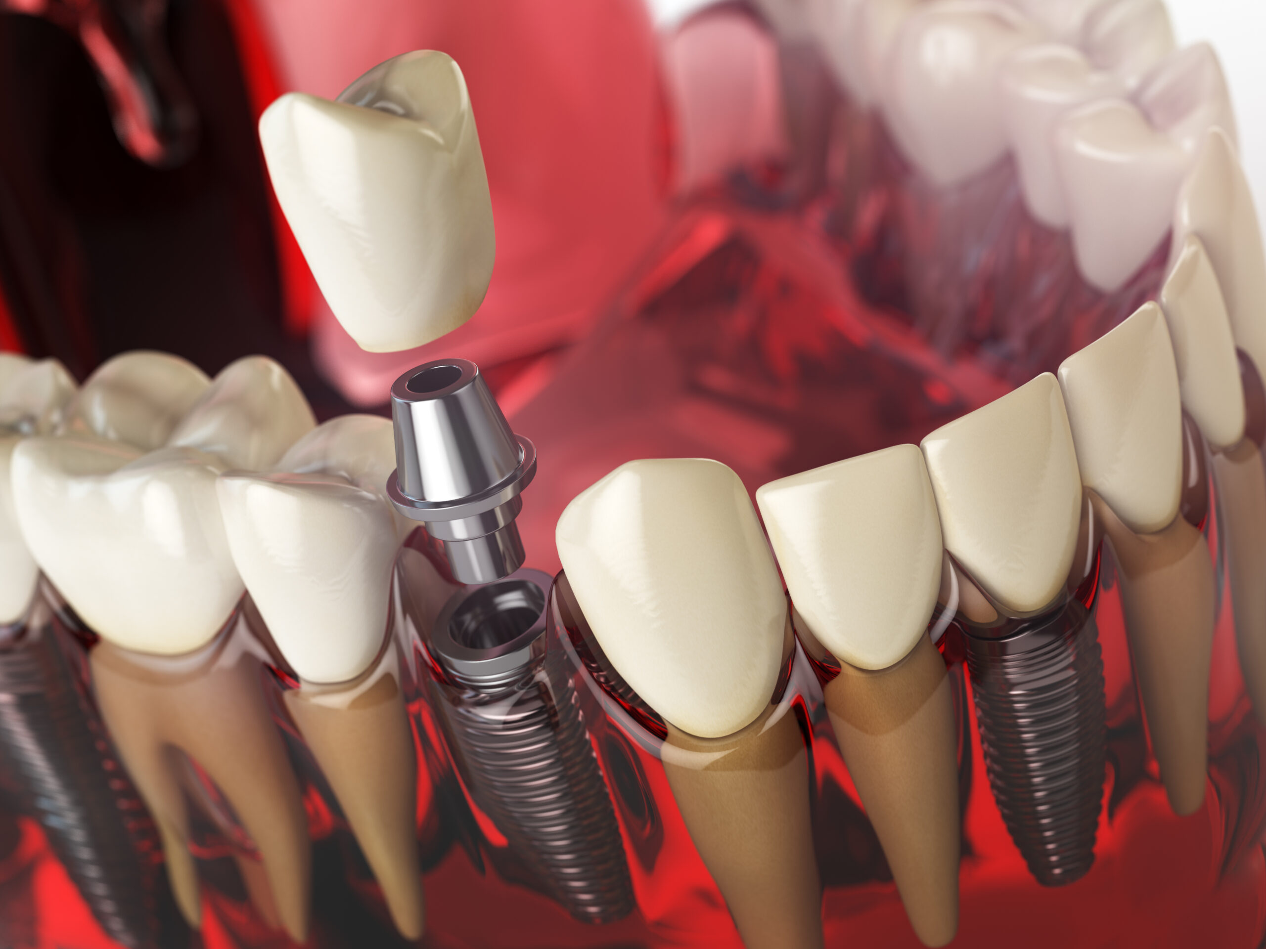 Implante dental en modelo 3D mostrando encía, tornillo y corona – Clínica Elena Queral en Castellón