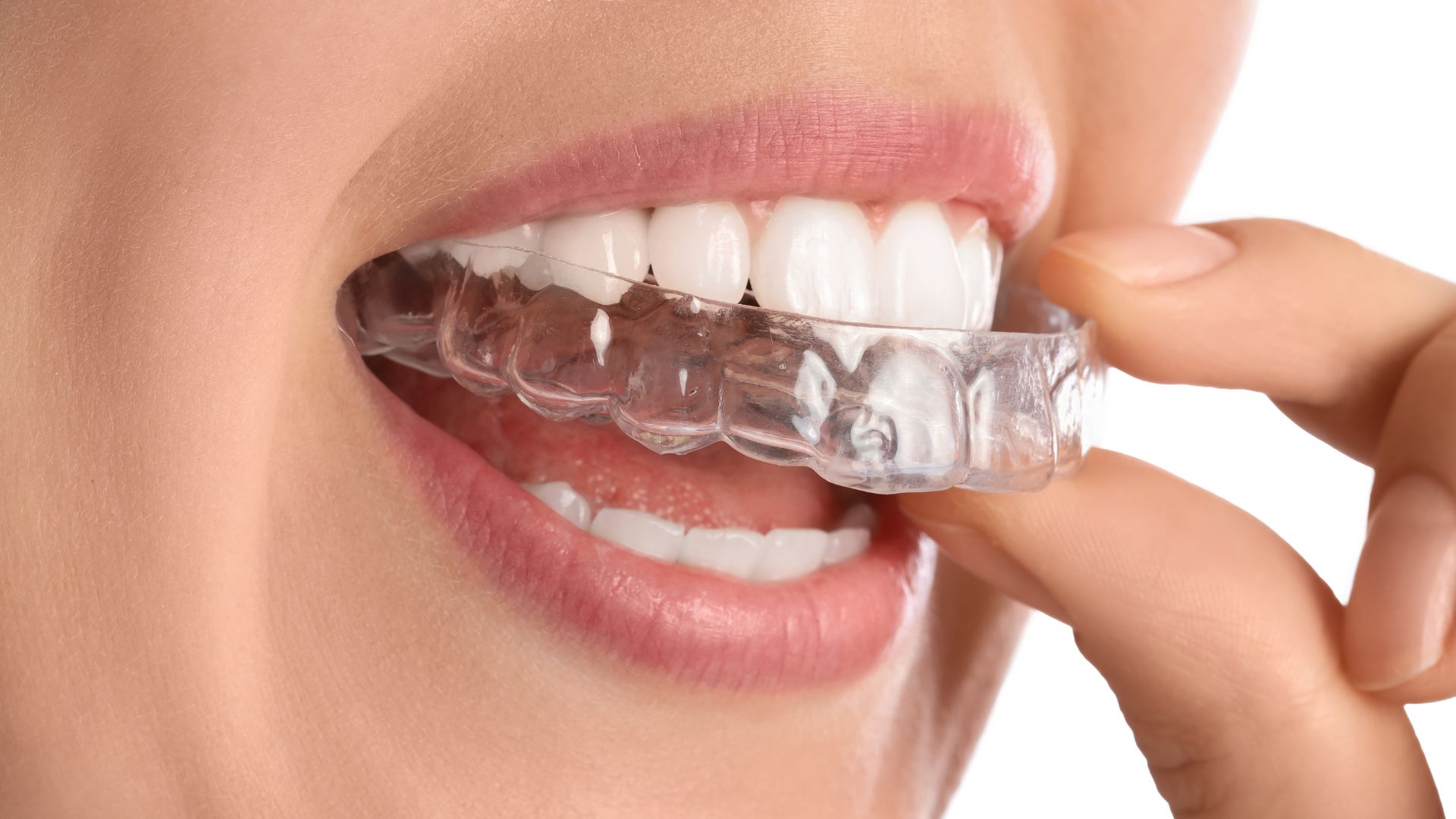 Cómo funciona la ortodoncia invisible