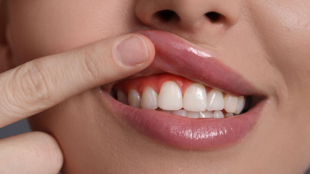 Causas más frecuentes del sangrado de encías y cómo actuar