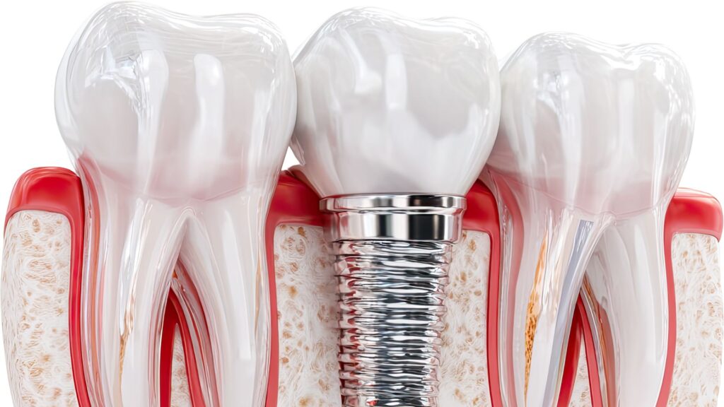 Qué son los implantes dentales y cómo son