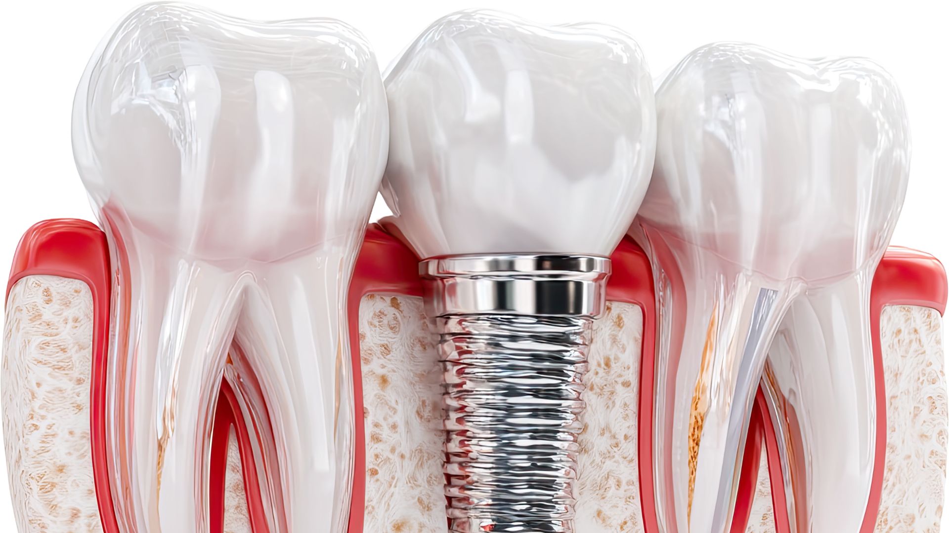 Qué son los implantes dentales y cómo son