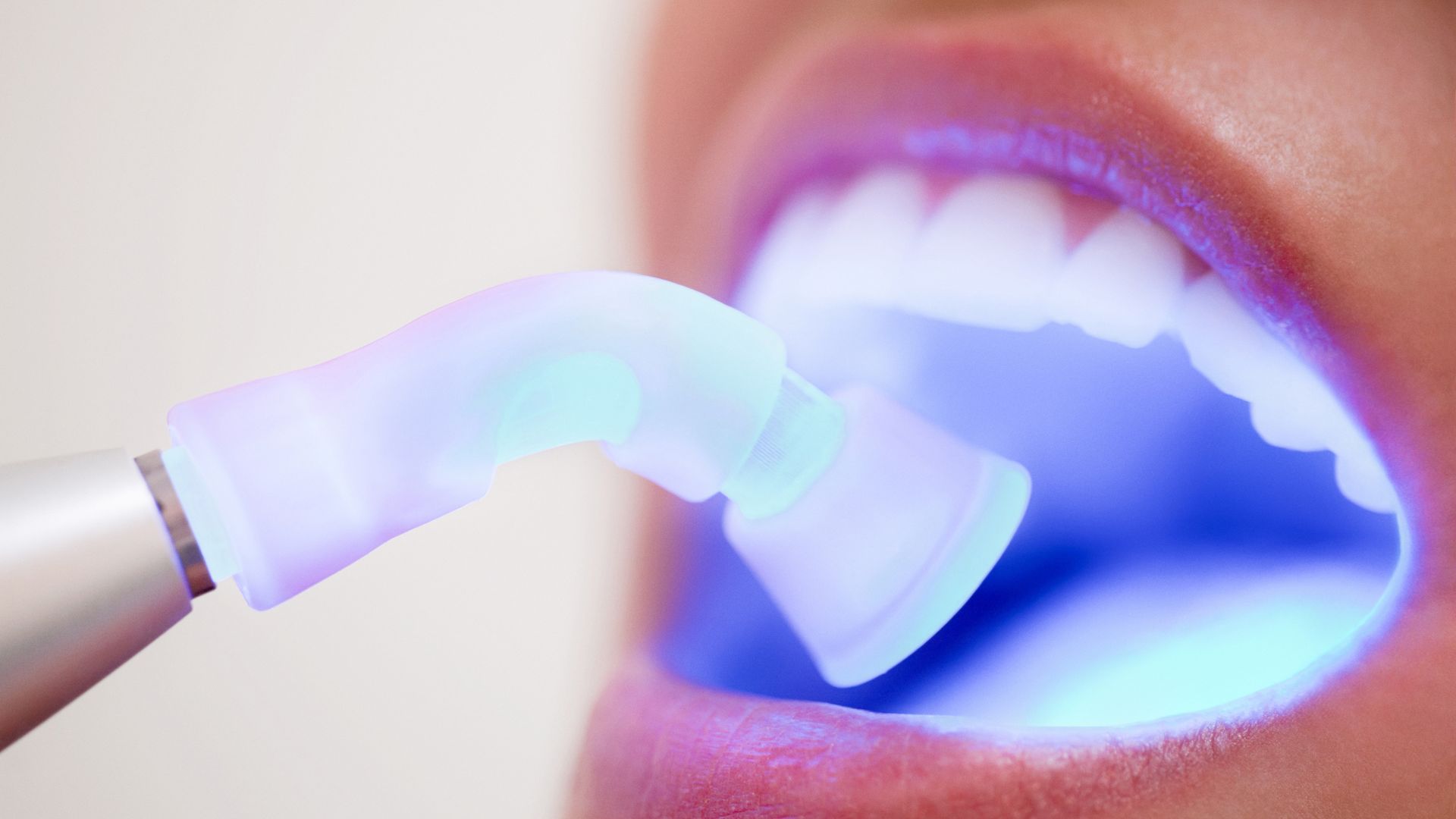 Se me ha caído un empaste qué hacer hasta ir al dentista